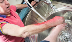 A man burned his hands | National burn awareness week